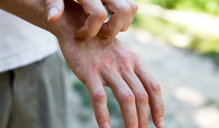 Types of eczema and homeopathy treatment