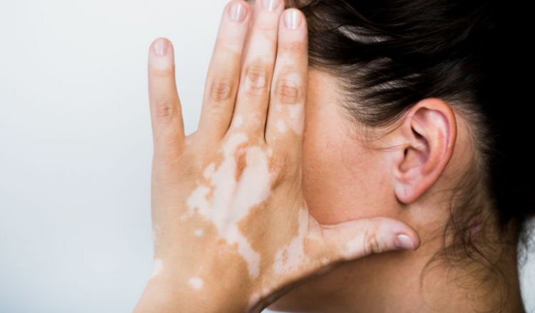 What are the causes of Vitiligo?