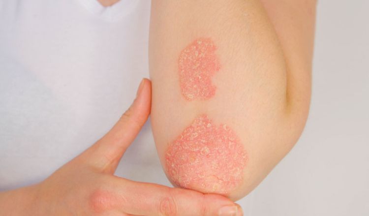 Signs to know if you've psoriasis