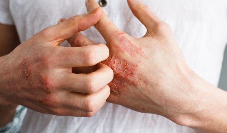 Eczema and mental health: What's the connection?