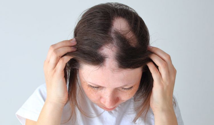 Causes of Alopecia