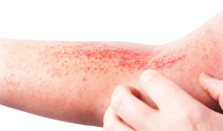 Eczema: Diagnosis & Treatments