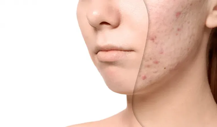 Are acne scars more than skin deep?