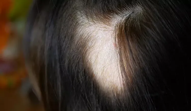 Is alopecia areata permanent?