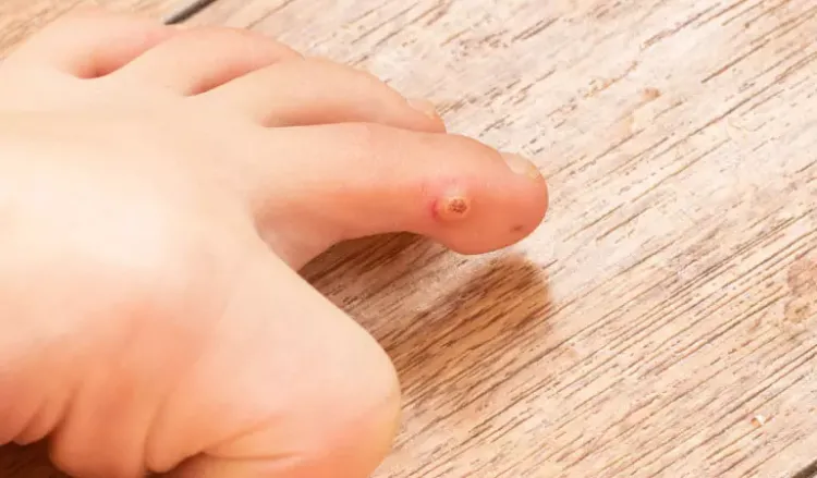 Homeopathy: Best treatment for warts