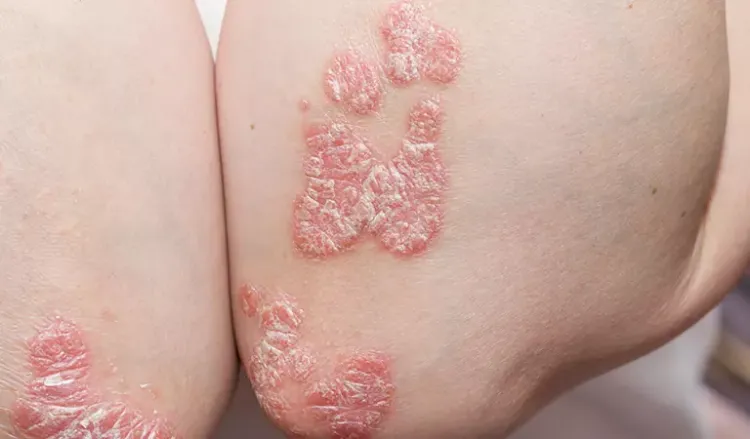 How can I stop psoriasis from spreading?