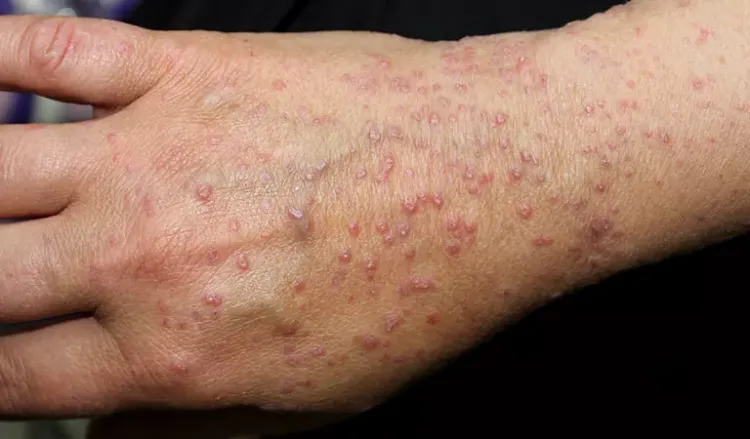 How long does lichen planus take to clear up?