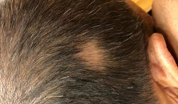 Is alopecia areata permanent?