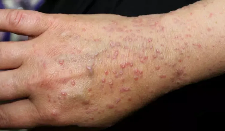 Treat Lichen Planus with Homeopathy