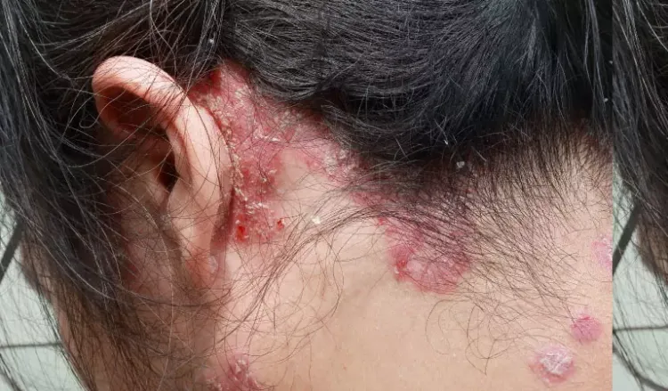 What does psoriasis look like on the scalp?