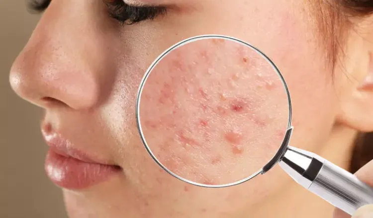 What are the different types of acne?