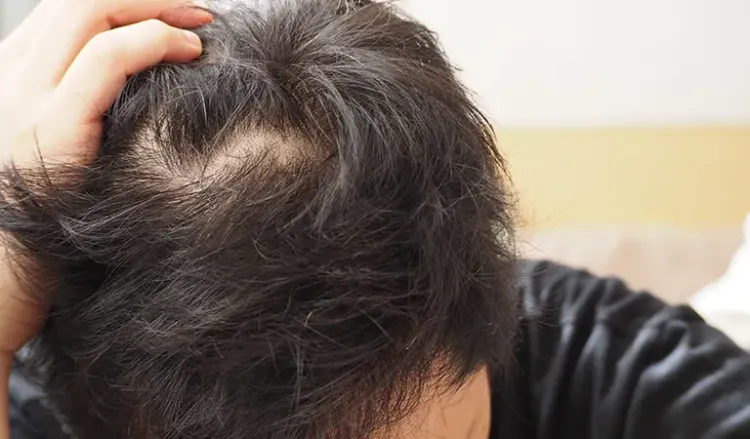 Dr Batra Hair Loss Treatment Review  Fraud hai scam  YouTube