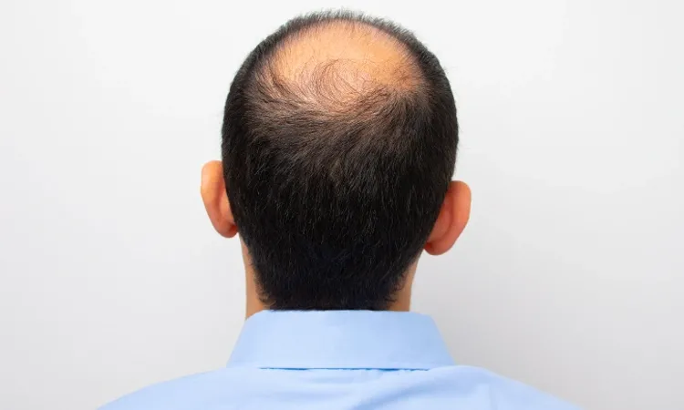 Cure for Male Pattern Baldness