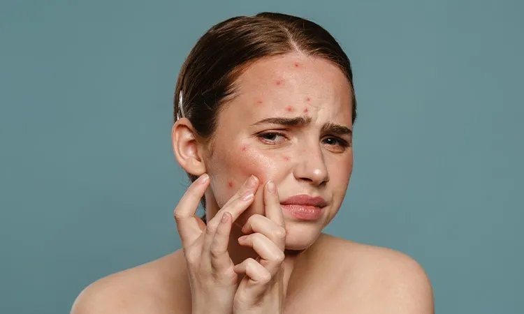 Treating Combination Acne and Personalized Care