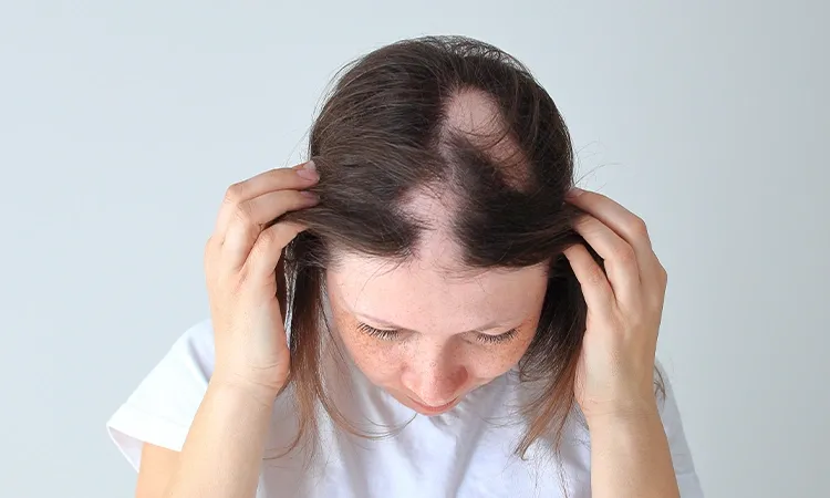 Hormonal Changes and Balding in Women