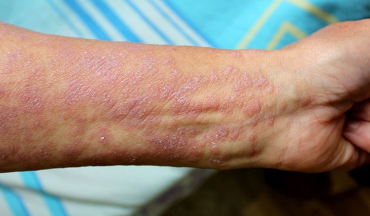  Lichen Planus with Natural Treatments