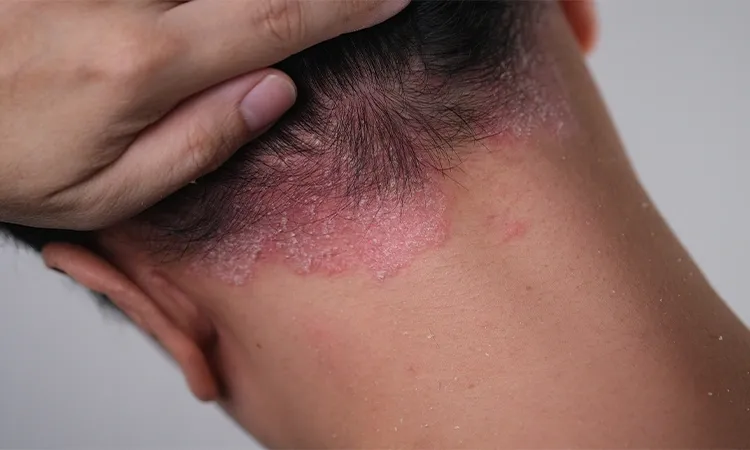 Side-Effects of Psoriasis Treatment