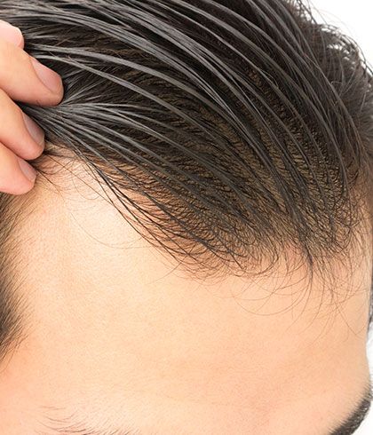 Can homeopathy help your hair grow back after thinning? | Dr Batra’s™