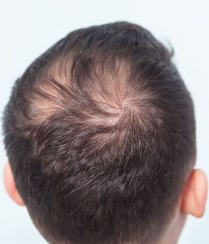 Preventive Tips for Male Pattern Hair Loss | Dr Batra’s™