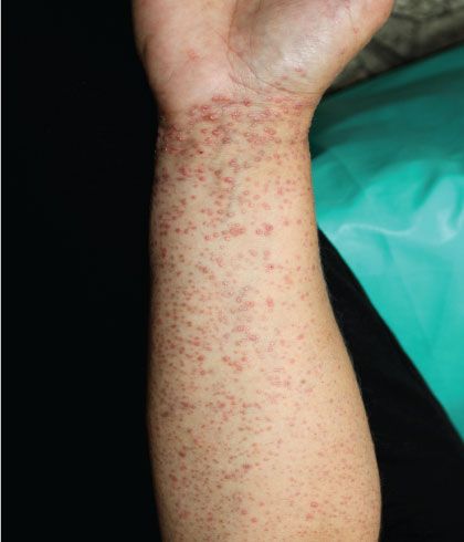 lichen planus homeopathy treatment