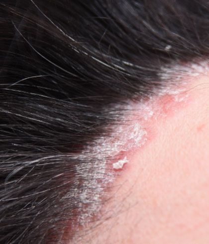 Scalp Psoriasis: Causes & Symptoms | Dr Batra’s™