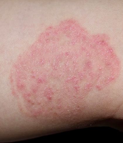 How to remove marks from skin infections? | Dr Batra’s™