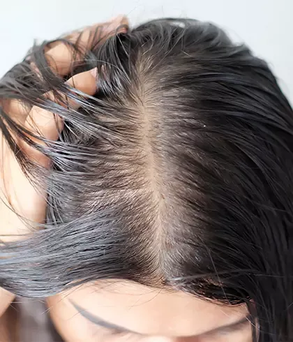 Causes of Hair Loss In Women  Hair Gro Therapy