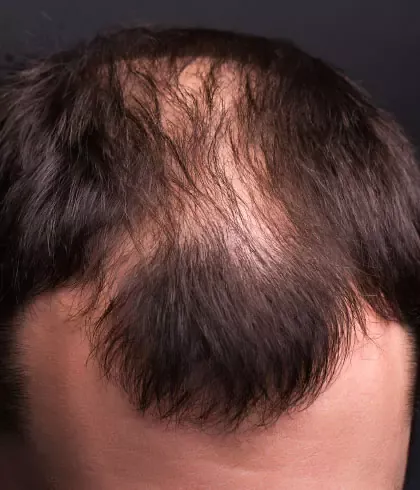 Can COVID19 Cause Hair Loss  MedPage Today
