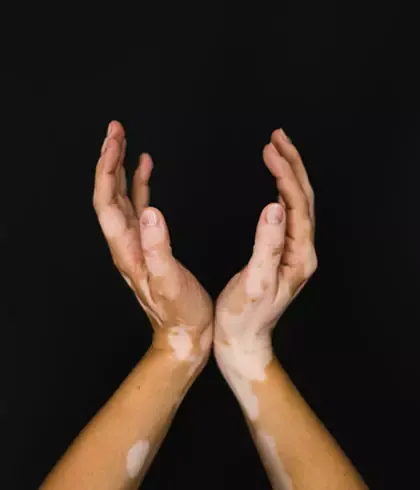 Know the early signs of vitiligo | Dr Batra’s™