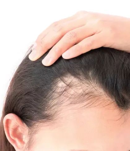 Hair Loss in Women or Thinning Hair Causes and Treatments