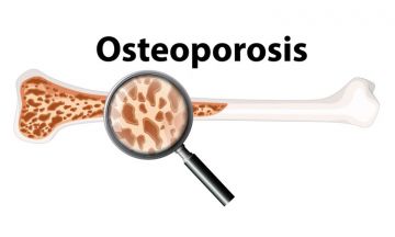 Osteoporosis is not always inherited. Know the causes and the symptoms.