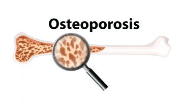 HOMEOPATHY & OSTEOPOROSIS