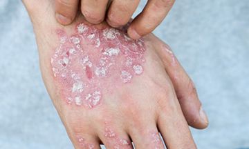 Combination of treatment plans for severe psoriasis