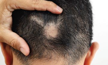 The Sikkim Today  tst ads Dr Batras Doctors are here to treat your Hair  Fall with Safe Effective and Long Lasting Homeopathy Treatment that has a  success rate of 94 To
