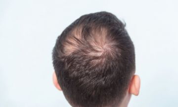 Preventive Tips for Male Pattern Hair Loss | Dr Batra’s™