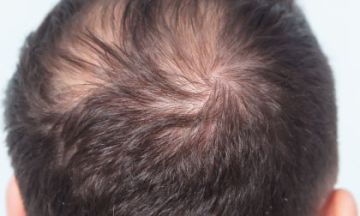 Preventive Tips for Male Pattern Hair Loss