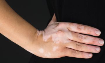 Leucoderma: Causes & Homeopathy Treatment