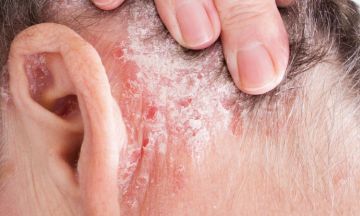 Know The 10 Complications Of Psoriasis | Dr Batra’s™