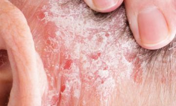 Know the 10 complications of psoriasis