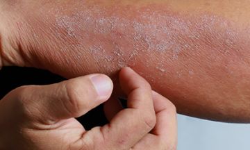 What Causes Skin Infections?