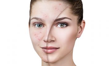 Homeopathy — Best Remedy for Acne.