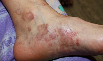 Lichen Planus & Depression — What's the Connection?