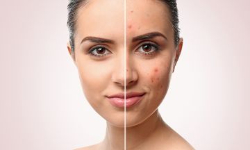 All You Need to Know About Acne