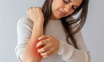 Top 5 surviving tips for itchy eczema days