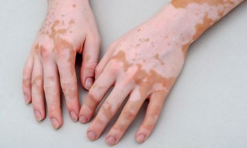 Homeopathy: Best treatment for Vitiligo