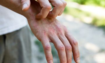 Types of eczema and homeopathy treatment