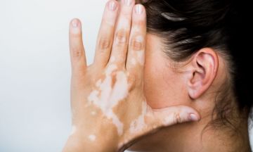 What are the causes of Vitiligo?