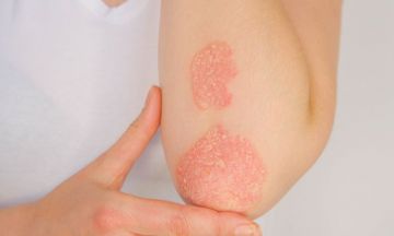 Signs to know if you've psoriasis