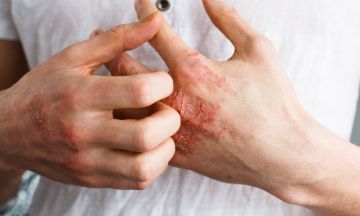 Eczema and mental health: What's the connection?