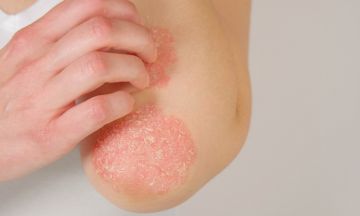 How to prevent psoriasis from recurring?